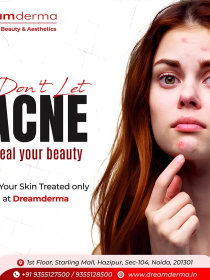 Acne shouldn't steal your beauty or your confidence. At our clinic, we provide expert care to treat active acne and prevent future breakouts, helping you reclaim your clear and beautiful skin.