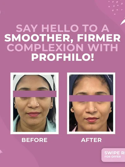 This before and after comparison shows the subtle yet impactful results of Profhilo. The treatment has visibly improved skin texture and firmness, providing a natural lift and a smoother, more radiant complexion.
