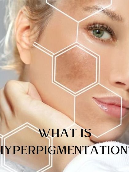 What is hyperpigmentation? It's the uneven skin tone or dark spots caused by excess melanin. I use a range of treatments from Carbon Facials and Laser Toning to skin boosters and chemical peels to tackle it at its root.