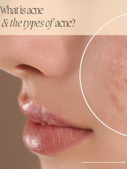 Understanding acne is the first step to treating it. This infographic provides a close-up look at how pores get clogged, leading to different types of acne.