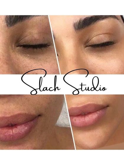 This result focuses on the delicate eye and mouth area, showing a reduction in fine lines and pigmentation for a more youthful look.