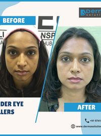 Anti-Aging Injectables & Lifts