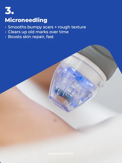 For leftover texture and scarring from back acne, I use microneedling. This treatment helps to smooth bumpy scars and rough texture by stimulating your skin's natural repair process.