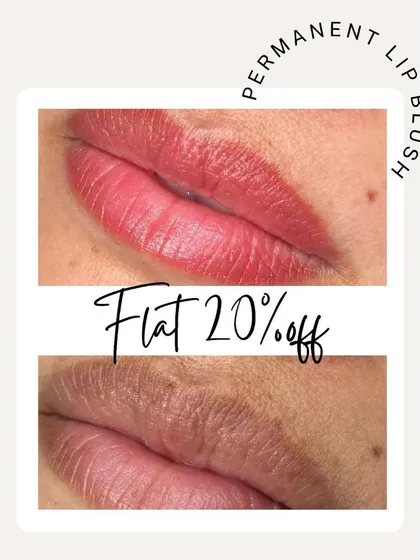 A classic lip blush result, this before-and-after shows the correction of dryness and dullness. The permanent tint adds a flush of color and gives the lips a hydrated, smooth appearance that lasts for up to two years.