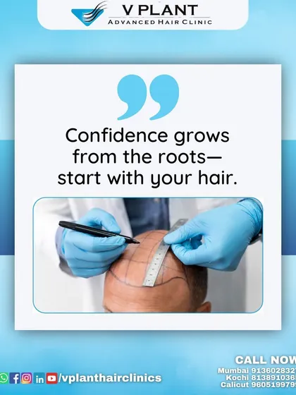 Confidence begins with precision. Here, you see a crucial step in our process: mapping the scalp for a hair transplant. This careful planning ensures that every graft is placed perfectly to create a natural hairline and achieve the density you desire. It’s not just about restoring hair, it’s about restoring you.