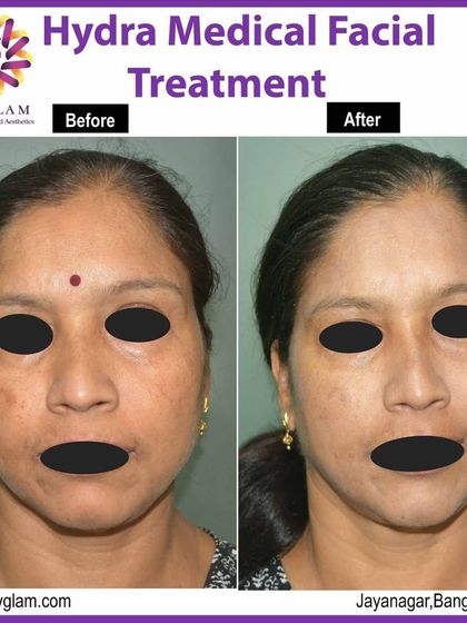 This before-and-after of a Hydra Medical Facial highlights the treatment's effectiveness in addressing pigmentation and dullness. The client's skin is visibly brighter and more even-toned post-treatment.