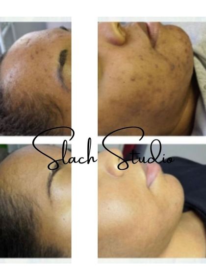 This collage displays the treatment's effectiveness from multiple angles, showing a comprehensive reduction in acne and pigmentation.