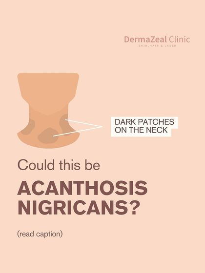 Noticing dark, velvety patches on your neck or underarms? It could be Acanthosis Nigricans. While it may seem harmless, it can be a sign of underlying health concerns that need to be addressed.