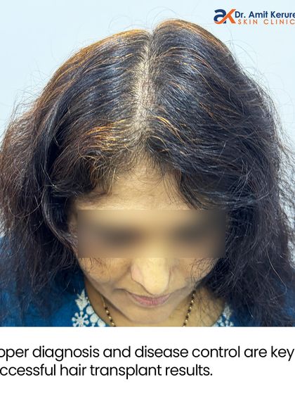 The 'after' photo shows the final result 12 months post-op. Proper diagnosis and controlling the disease were the keys to achieving this successful hair transplant outcome.