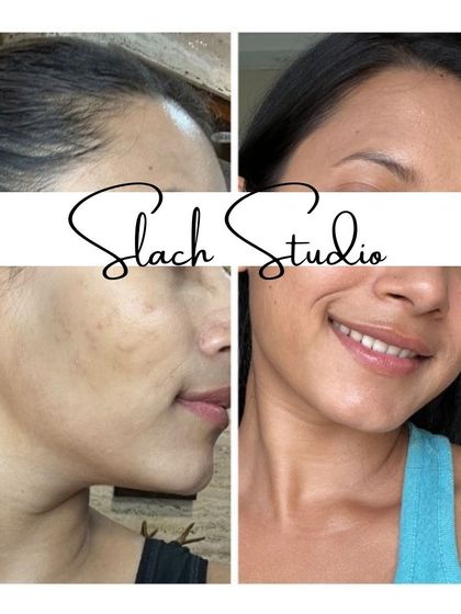 This happy client is smiling, showing off her newly radiant skin, free from the spots and uneven tone she had before.