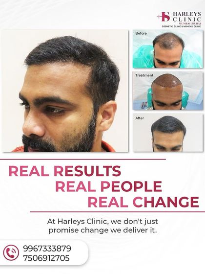 Real results for real people. This image shows the three key stages of transformation: the initial hair loss, the scalp immediately after the transplant procedure, and the final, fully grown-in result.
