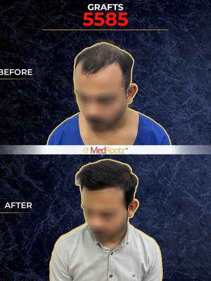 We used a total of 5,585 grafts for Naseem's surgery. This high number was necessary to achieve the density he wanted, and the result is a full head of hair that has completely changed his look.