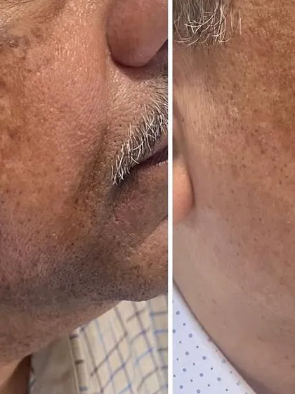Addressing stubborn pigmentation requires a strategic approach. This result was achieved for a male patient using a combination of targeted in-clinic treatments and a dedicated skincare regimen designed to manage and reduce hyperpigmentation.