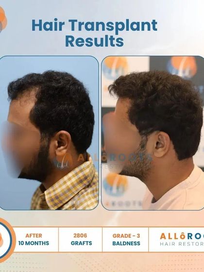 This 10-month result for a Grade 3 baldness case, using 2806 grafts, showcases a significant improvement in density and a perfectly restored hairline from all angles.
