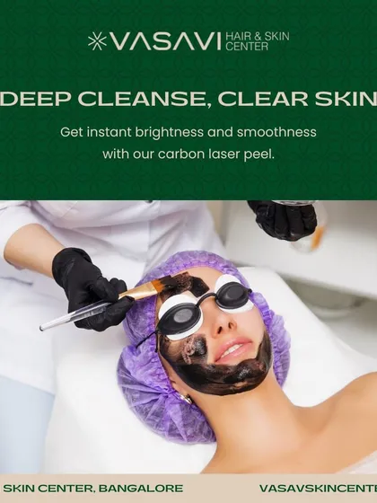 This image captures a Carbon Laser Peel in progress. A layer of liquid carbon is applied to the skin, which is then targeted by a laser. This process deeply cleanses, exfoliates, and provides an instant brightening effect with no downtime.