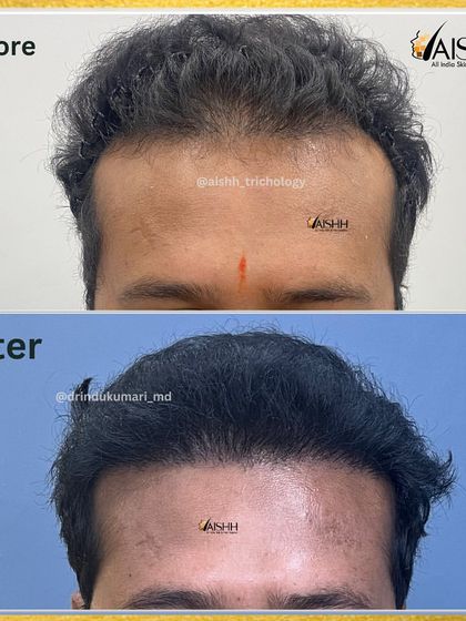 This before-and-after focuses on hairline construction. The 'after' shot shows a dense, natural, and perfectly framed hairline 7 months post-procedure.