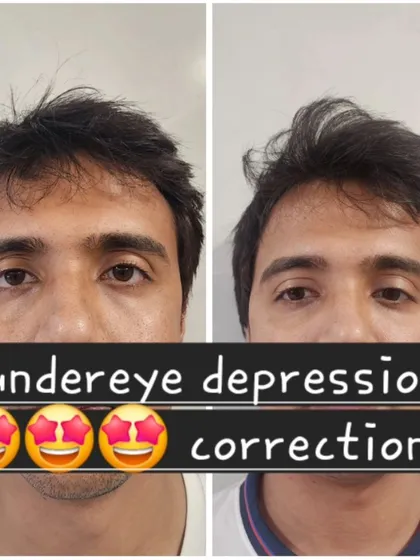 Anti-aging treatments are for everyone. This before and after demonstrates the correction of under-eye depression in a male client using fillers, effectively reducing the tired look and creating a smoother, more energized appearance.