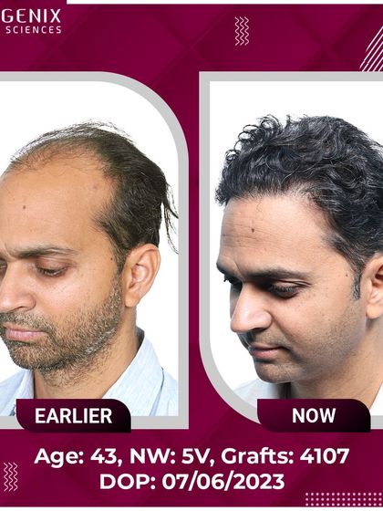 See the transformation of a 43-year-old with Grade 5V baldness, restored with 4107 grafts for a natural, lasting result.