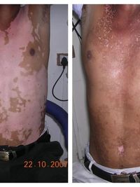 Vitiligo Treatment