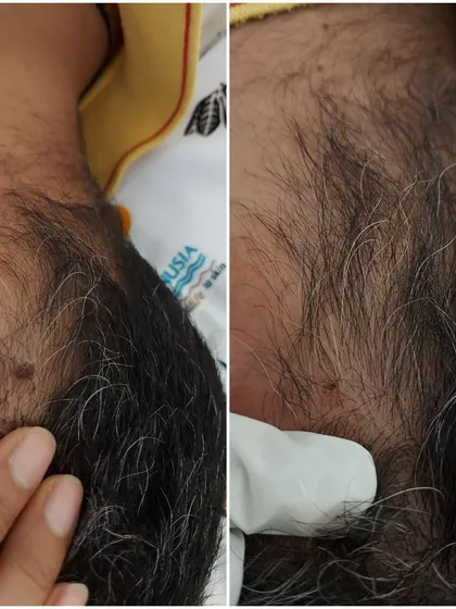 This patient had a small but noticeable growth on their hairline. The 'after' photo shows the spot post-removal, which will heal to blend seamlessly with the surrounding skin.