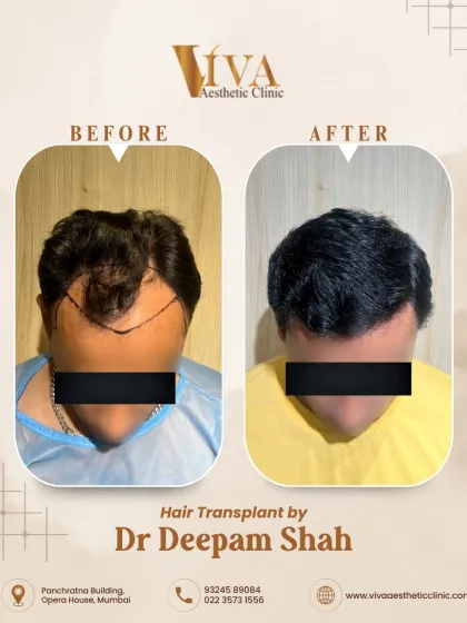 This is a classic example of restoring a receding hairline for a patient with Grade 3 hair loss. With 2500 grafts, we brought the hairline forward and added density, achieving this natural look in just 9 months.