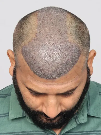 This is what a scalp looks like immediately after the procedure. Each dot is a carefully placed graft, the foundation of a future full head of hair.