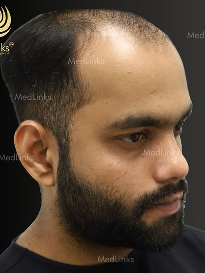 The patient's hair before the procedure, showing a receding hairline and thinning on top.