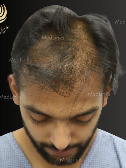 This patient's before photo shows significant thinning on the top of his head, a condition that often affects self-esteem. Our goal was to restore density and create a fuller look.