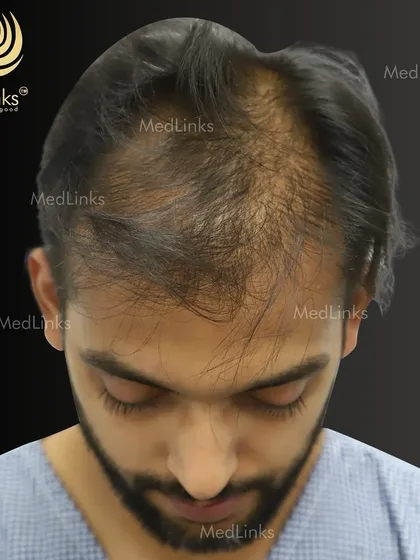 This patient's before photo shows significant thinning on the top of his head, a condition that often affects self-esteem. Our goal was to restore density and create a fuller look.