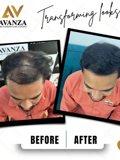 This transformation speaks for itself. We restored density across the entire top of the scalp, resulting in a thick, lush head of hair.