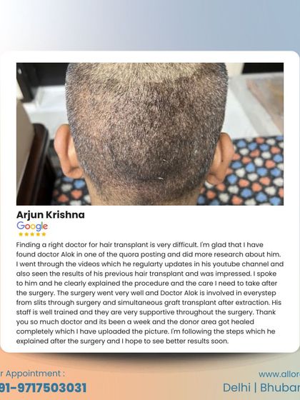 Finding the right doctor can be difficult. Arjun Krishna shares how he found me through research and was impressed by the results. His review notes my involvement in every step, from slit creation to simultaneous graft transplant, and the supportive nature of my team.