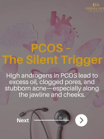 PCOS is a silent trigger for acne. This visual explains that high androgens in PCOS lead to excess oil and stubborn acne, especially along the jawline.