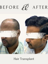 Hair Restoration