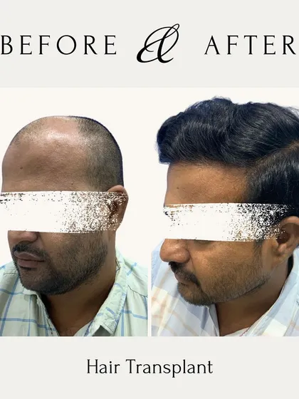 This before and after image shows a complete hair transformation. My focus is on creating a dense, natural-looking result that restores not just hair, but also confidence. This is a permanent solution to hair loss.