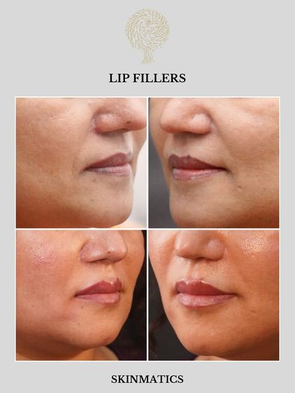 Skinmatics - Facial Aesthetics & Anti-Aging Dermal Fillers: Sculpt & Restore Volume photo 3