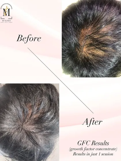 The results speak for themselves. This client achieved significant hair regrowth and improved thickness after just one session of Growth Factor Concentrate (GFC) therapy. My goal is to help you get your confidence back with visible results.