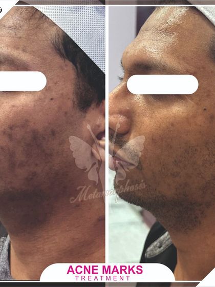 Another angle showing the successful reduction of acne marks and improved skin texture for our male client.