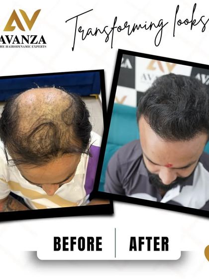 From faded to fabulous. This client's advanced hair loss was completely reversed, giving him a lush, full mane that exudes style and confidence.