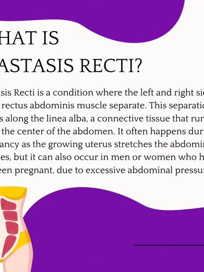 This graphic provides a clear, illustrated definition of diastasis recti, explaining how the rectus abdominis muscles separate along the linea alba to accommodate a growing baby.