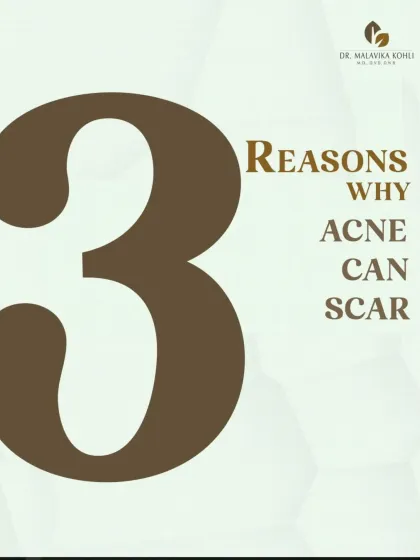 Understanding the reasons why acne may lead to scarring is crucial for prevention. The potential for scarring is influenced by several key factors that I address with my patients.