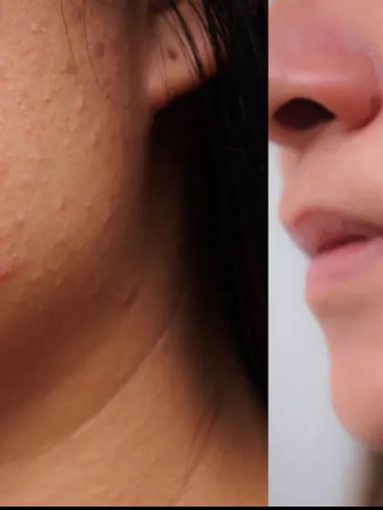 A clear demonstration of moving from active, painful acne to clear, smooth skin. My goal is to restore skin health and give my patients the confidence to feel good in their own skin.