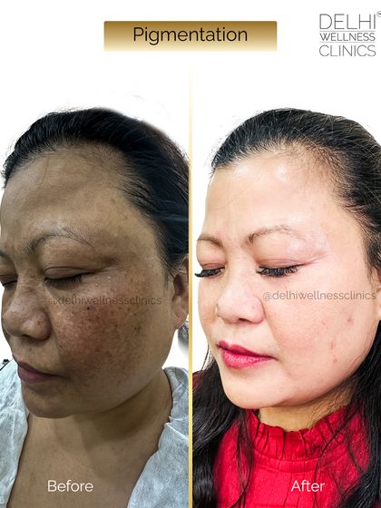 This client came to me with deep facial pigmentation. This before and after photo shows the incredible transformation, with significantly clearer and brighter skin.