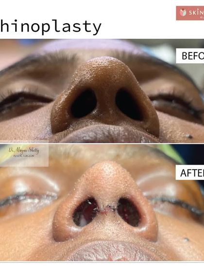 This before-and-after from a lower angle shows how rhinoplasty can refine a broad or boxy tip. The goal is always subtlety and balance, ensuring the final result enhances the entire face without drawing undue attention.