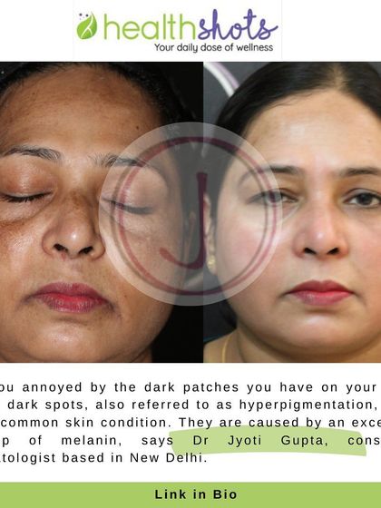 This before and after, featured in a Healthshots article, illustrates a successful treatment for hyperpigmentation. The patient's dark patches have visibly faded, resulting in a brighter and more even skin tone after a course of personalized treatments.