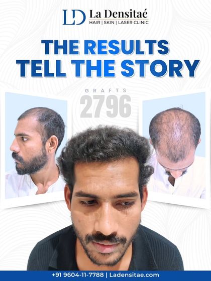 The goal of a great hair transplant is for no one to know you had one. With 2,796 grafts, I focused on creating a natural look with seamless fullness. This result proves that you don't have to avoid mirrors when you can fix the problem for good.