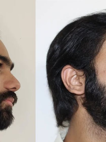 From the side, the new hairline looks completely natural. The hair grafts are angled to mimic natural growth patterns, making the transplant undetectable.