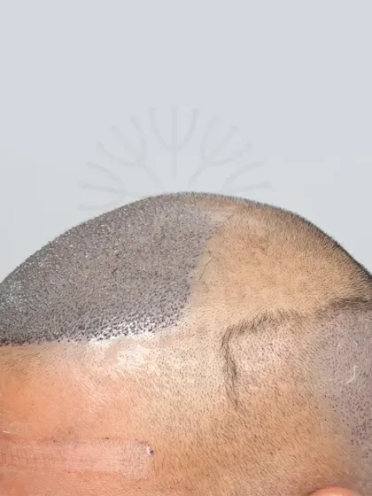 A Grade 4A hair loss case restored with 3500 grafts. These images show the precision of our graft placement.