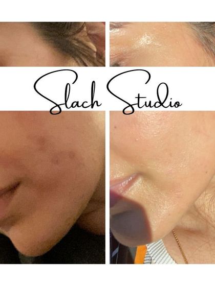 Another fantastic transformation, this client's skin is visibly brighter and smoother after her Korean Glass Skin session.