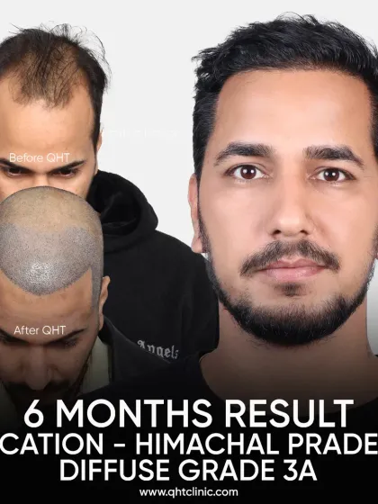 Just 6 months in, and this patient from Himachal Pradesh with Grade 3A baldness already shows remarkable growth and a shaping hairline.