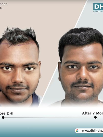 A frontal before and after of the 20-year-old client. The restored hairline and fuller look have given him a renewed sense of confidence just 7 months after his hair transplant.